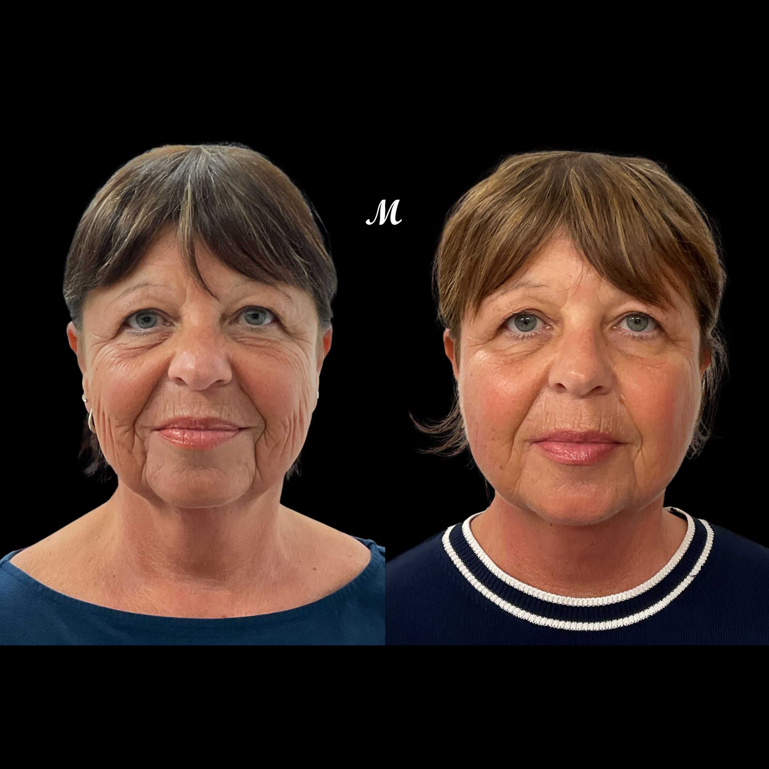 Nose Thread Lift